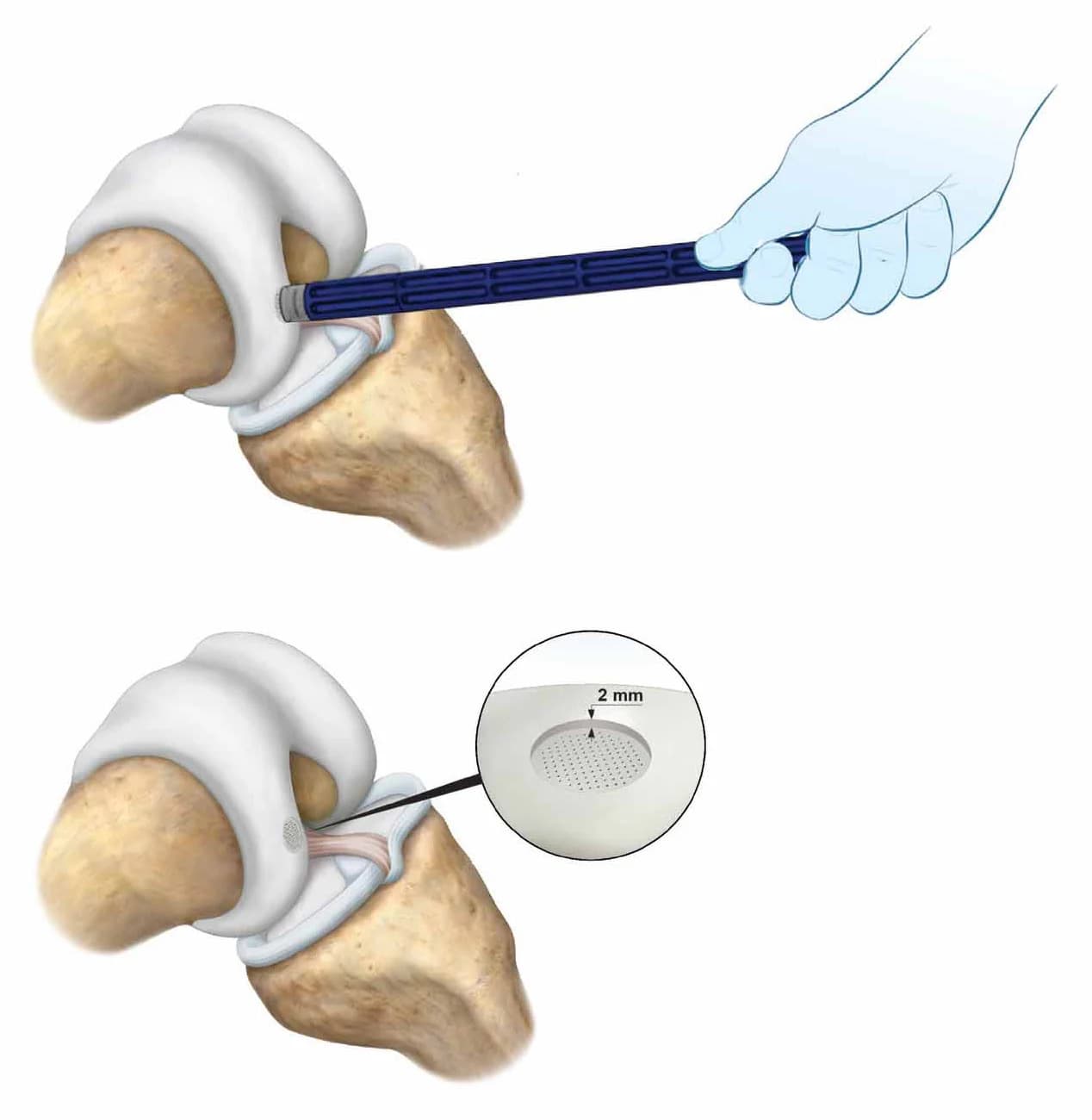 CartiHeal Agili-C implant being seated into a prepared knee cartilage lesion